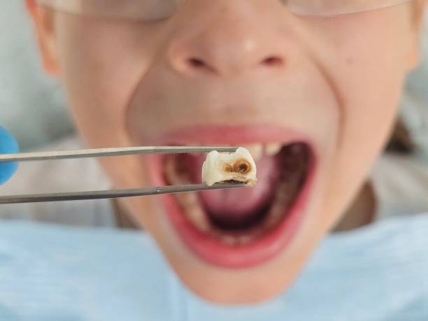 Best Broken or Cracked Tooth Emergency Dentist in Averill Park, NY
